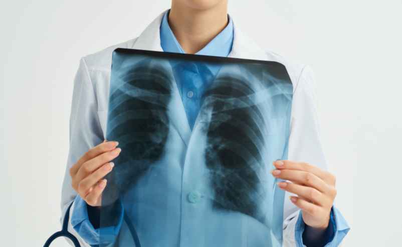 Quelle est la différence entre une pneumonie et une pneumopathie ?-Maurice Vincent